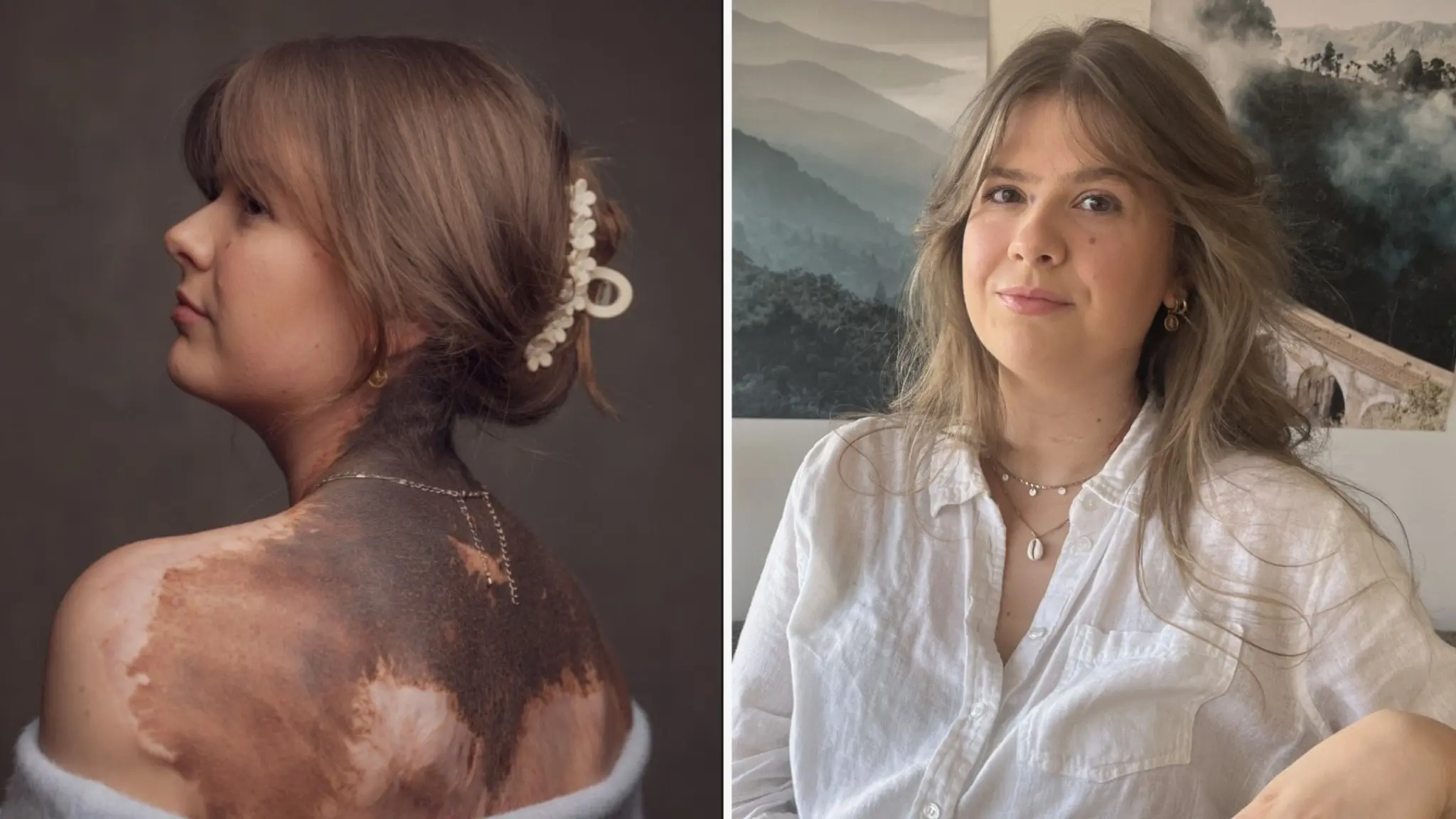 Anna Hasselfors visar upp sitt stora födelsemärke på ryggen och håret uppsatt med håraccessoar. Till höger Anna Hasselfors med långt hår, vit skjorta och landskapsmålning i bakgrunden.